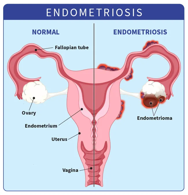 contoh endometriosis